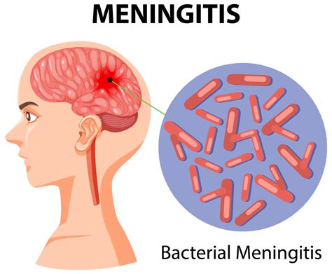 Následky po prekonaní meningitídy