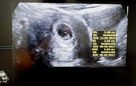 Návšteva gynekológa pre potvrdenie tehotenstva
