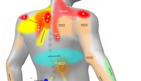 Diagram: Miesta bolesti pri zamlčanom potrate