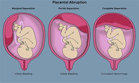 Image illustrating placental abruption