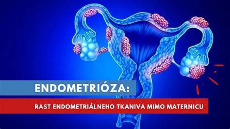 Rozšírenie endometriózy v tele