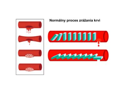 Porovnanie normálneho a mimomaternicového tehotenstva