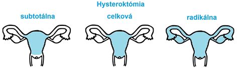 Typy hysterektómie