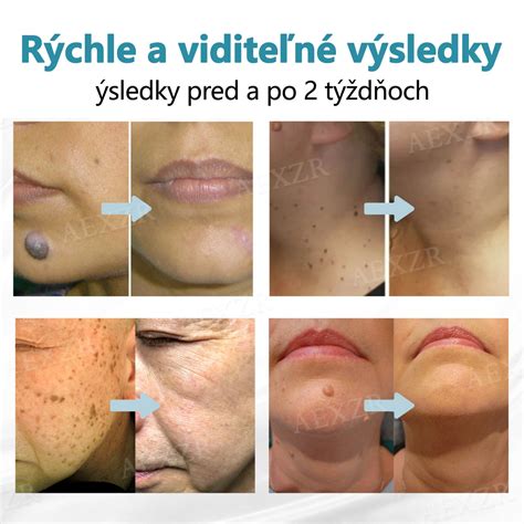 Vizuálne zobrazenie rôznych typov genitálnych bradavíc