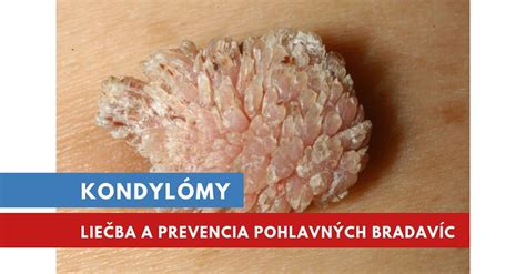 Genitálne bradavice - symptómy a lokalizácia