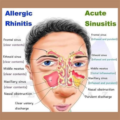 Symptoms of rhinitis and sinusitis