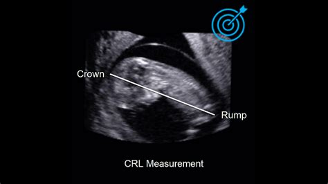 Schéma merania CRL (Crown-Rump Length) plodu