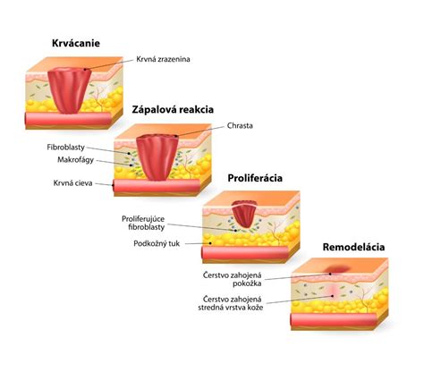 infografika znázorňujúca proces hojenia po chirurgickom zákroku na hymene