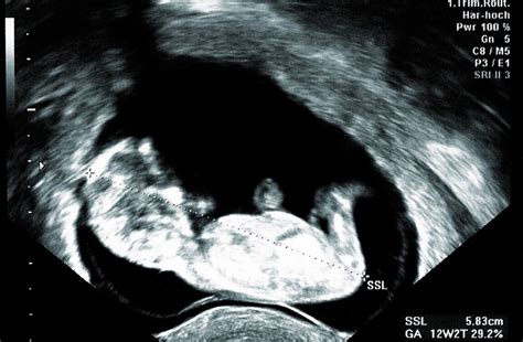 Ultrazvukový snímok bábätka v 16. týždni tehotenstva