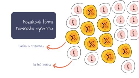 Zjednodušená infografika chromozómov s vyznačenou trizómiou 21 (Downov syndróm)