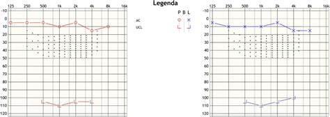 Ukážka audiometrického vyšetrenia a audiogramu