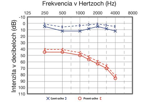 Audiogram s vysvetlením prahov počutia a typov poruchy sluchu