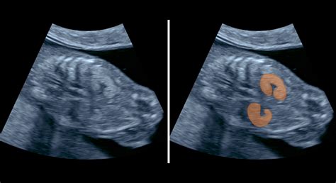 3D obrázok gastroschízy plodu v 12. týždni