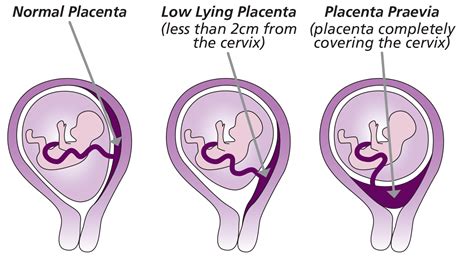 Diagram placenty praevia