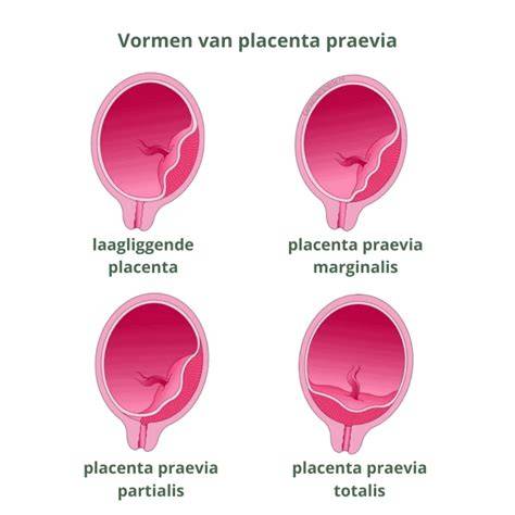 Typy placenty praevia (marginalis, partialis, totalis)