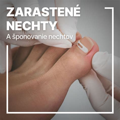 Aplikácia nechtovej špony