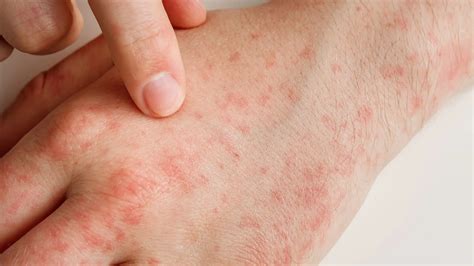Deti s kožnými vyrážkami (alergia)