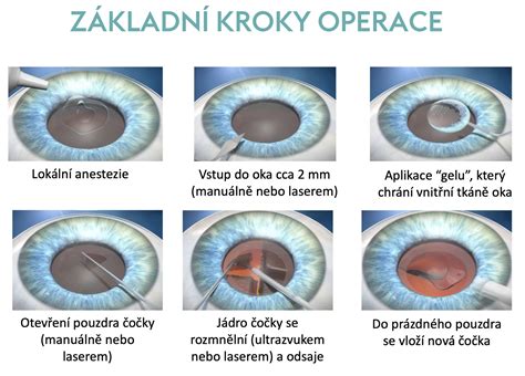 Porovnanie ultrazvukovej a laserovej metódy operácie šedého zákalu