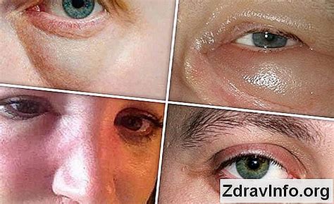Závažný opuch tváre vyžadujúci lekársku pomoc