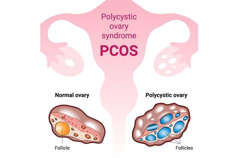 Porovnanie zdravého vaječníka a vaječníka s PCOS