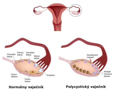 Schéma polycystických vaječníkov a normálnych vaječníkov