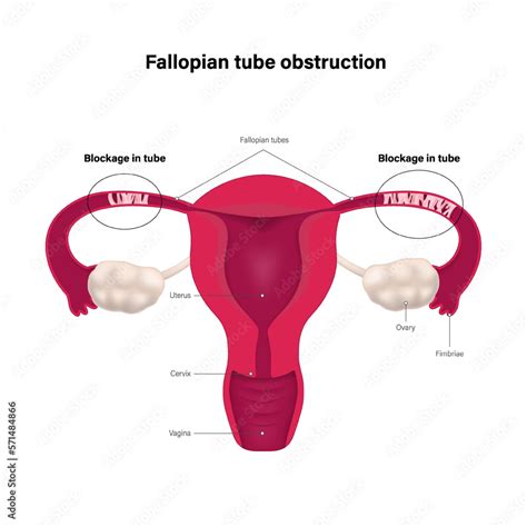Illustration of female reproductive system with one fallopian tube
