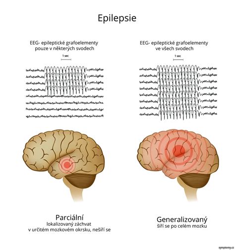 Infografika zobrazujúca rôzne typy epileptických záchvatov