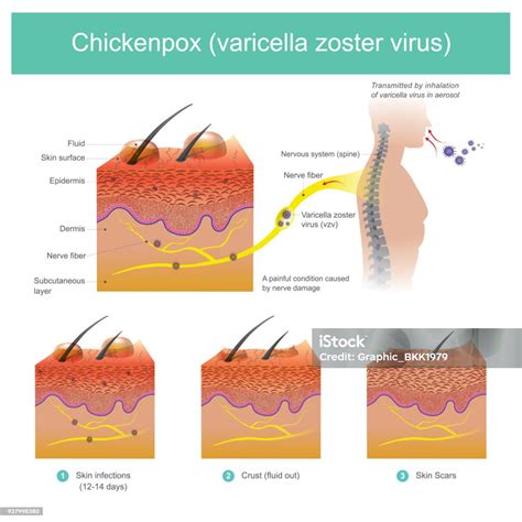Pásový opar: Vírus varicella zoster a jeho reaktivácia