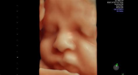 ultrazvukové zobrazenie plodu v maternici