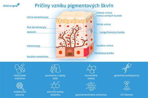 Druhy pigmentových škvŕn