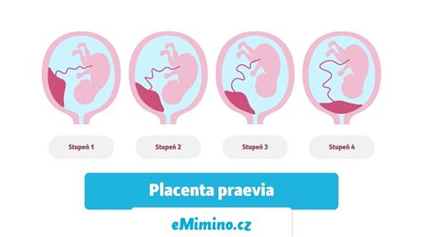 Schématické znázornenie normálnej placenty, prednej placenty a vcestnej placenty (placenta praevia)