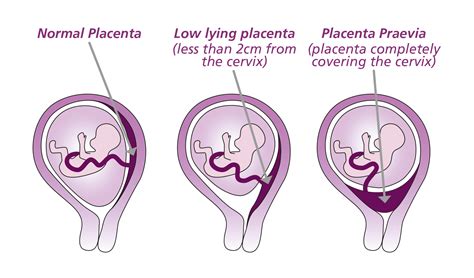 Vizualizácia typov placenta praevia