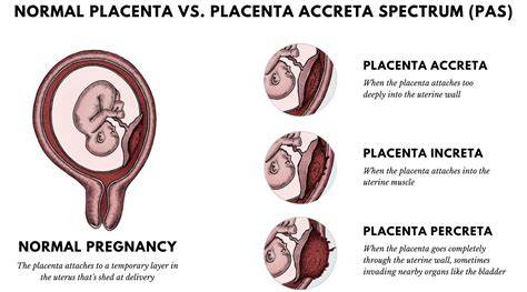 Porovnanie normálnej placenty a placenty accreta/percreta (vrastená placenta)