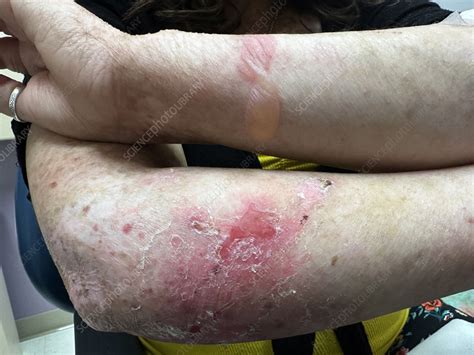 Dieťa s epidermolysis bullosa a pľuzgiermi na koži