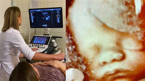 Ultrazvukové vyšetrenie plodu