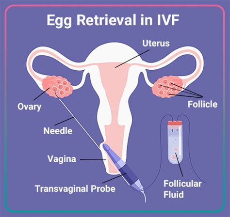 Graphic of egg retrieval procedure