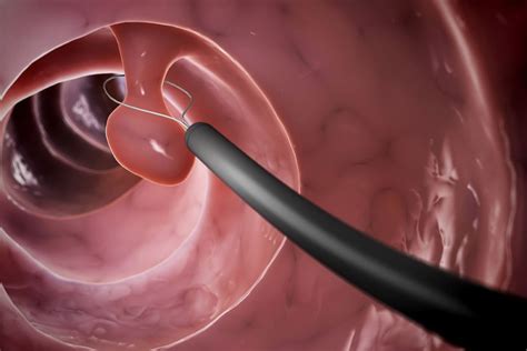 Maternicový polyp