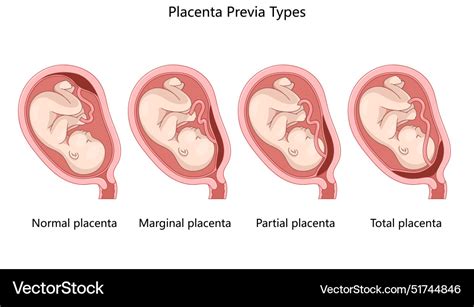 Placenta praevia increta - schéma