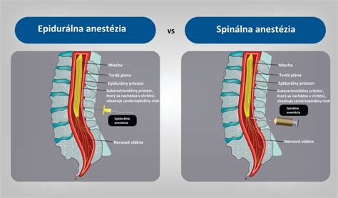 Spinálna anestézia pri cisárskom reze