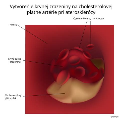 Zobrazenie krvnej zrazeniny v cieve