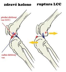 Schéma stupňov roztrhnutia hrádze