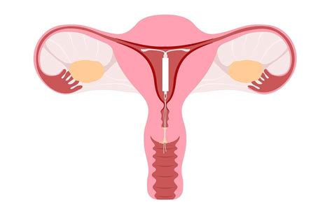 Ilustračný obrázok vnútromaternicového telieska Mirena