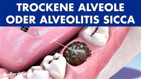 Suché lôžko (alveolitis sicca) - schematický pohľad