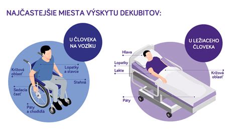 Mapa: Najčastejšie miesta vzniku preležanín (dekubitov)