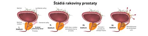 Vplyv rakoviny prostaty na mužské reprodukčné orgány