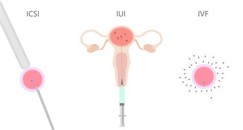Schéma metód asistovanej reprodukcie, porovnávajúca IUI, IVF a ICSI