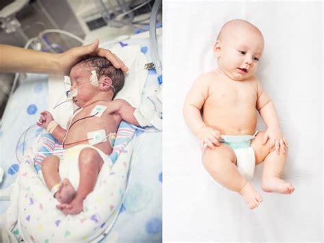Comparison of a full-term baby vs. a premature baby