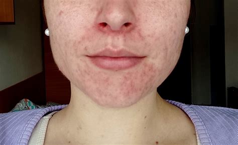 Tínedžer s problematickou pleťou