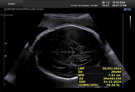 ultrasound measurement