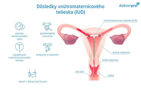Ilustrácia vnútrotelového telieska Mirena
